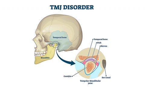 Headaches and TMJ Problems - PDR Physical Therapy and Wellness Center